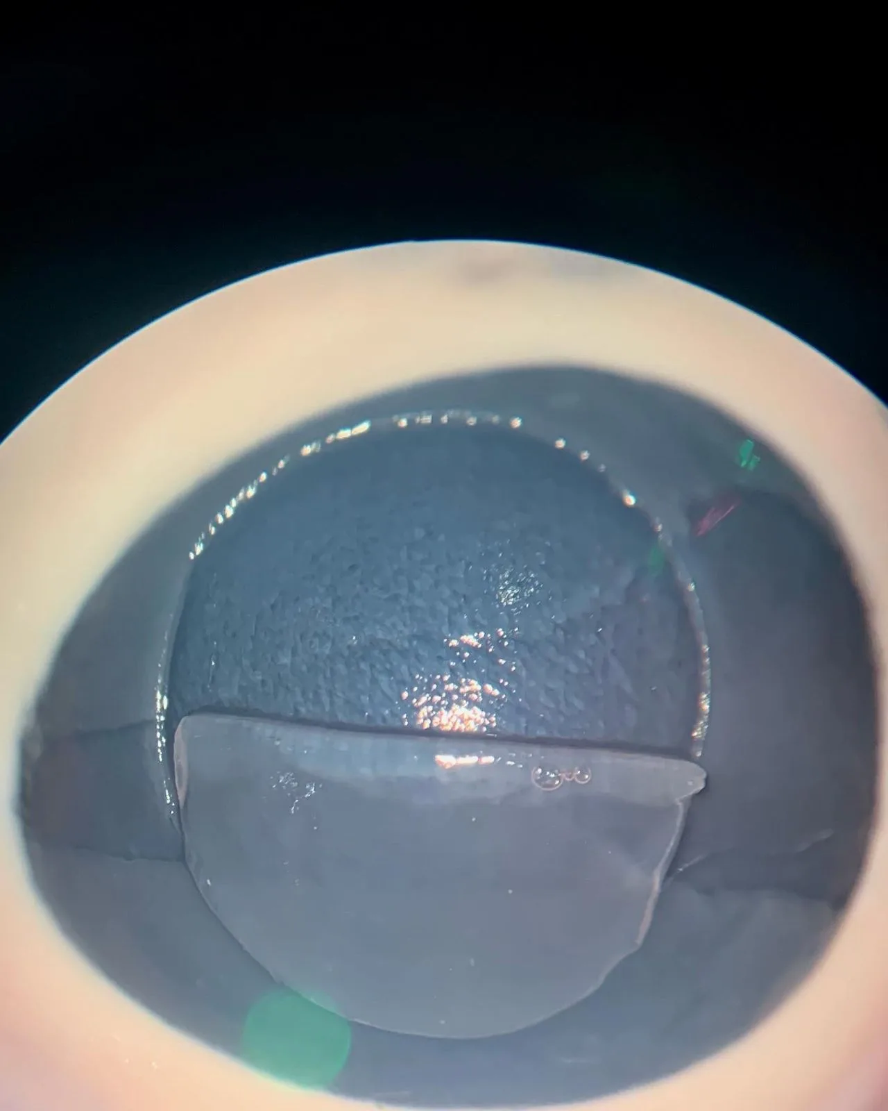 Exemplo de Flap, corte na córnea, da cirurgia refrativa utilizando a técnica Lasik